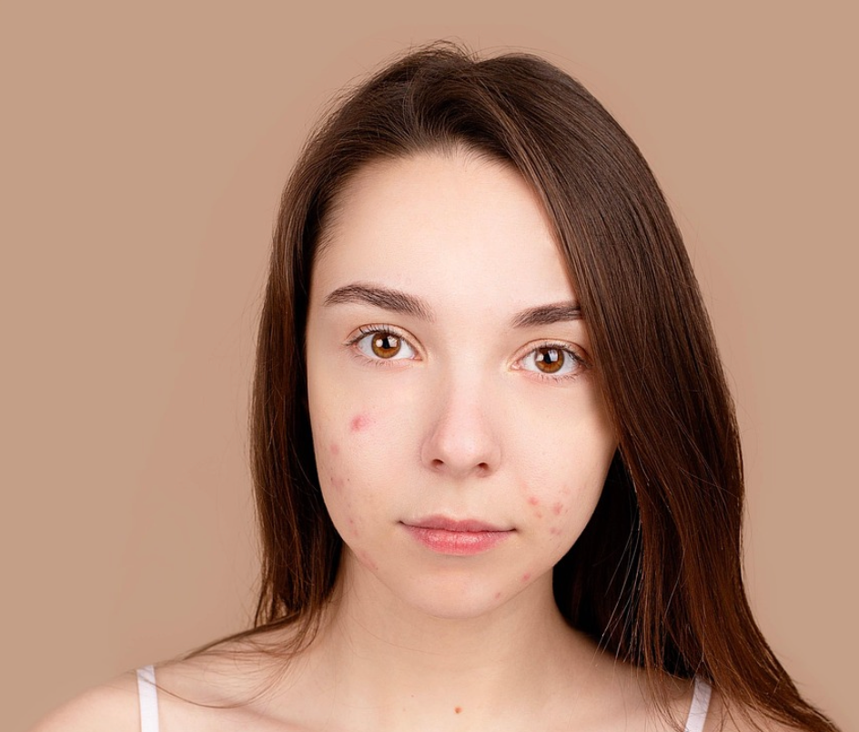 Dermatologo especialista en Acne en la piel rostro espalda brazos nariz, tratamiento y soluciones caseras para el Acne jovenes y adultos, el mejor doctor en la CDMX, Medico para Acne, Doctor especialista en Acne en Mexico Dermatologo especialista en Acne en la piel rostro espalda brazos nariz, tratamiento y soluciones caseras para el Acne jovenes y adultos, el mejor doctor en la CDMX, Medico para Acne, Doctor especialista en Acne en Mexico