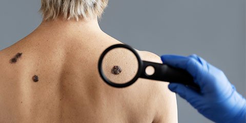 Dermatologo, El mejor dermatólogo, CDMX, Especialista en la piel, Manchas, Lunares, Acne, Sintoma de la piel, Dermatitis, Doctor, Doctores, Medico, Medicos, Consultorio Dermatologo, El mejor dermatólogo, CDMX, Especialista en la piel, Manchas, Lunares, Acne, Sintoma de la piel, Dermatitis, Doctor, Doctores, Medico, Medicos, Consultorio